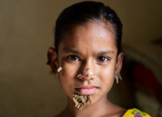 Девочка из Южной Азии – стала первым ребенком с синдромом «человека-дерева»