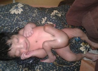 Мальчика, который родился с четырьмя ногами и двумя половыми органами успешно прооперировали