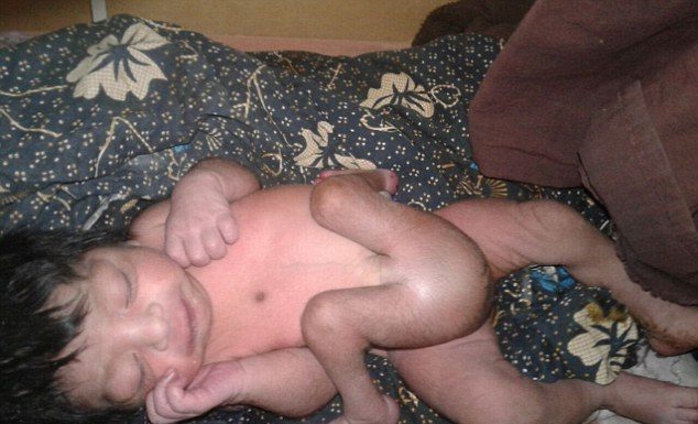 Мальчика, который родился с четырьмя ногами и двумя половыми органами успешно прооперировали