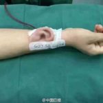 Китайские хирурги вырастили ухо