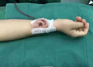 Китайские хирурги вырастили ухо