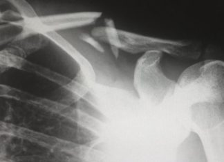 Пять мифов о переломы костей